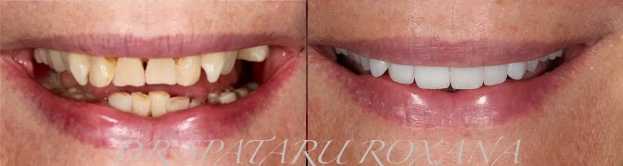 facette dentaire avant apres facette dentaire limage prix d une facette dentaire avis docteur roxana spataru paris 1